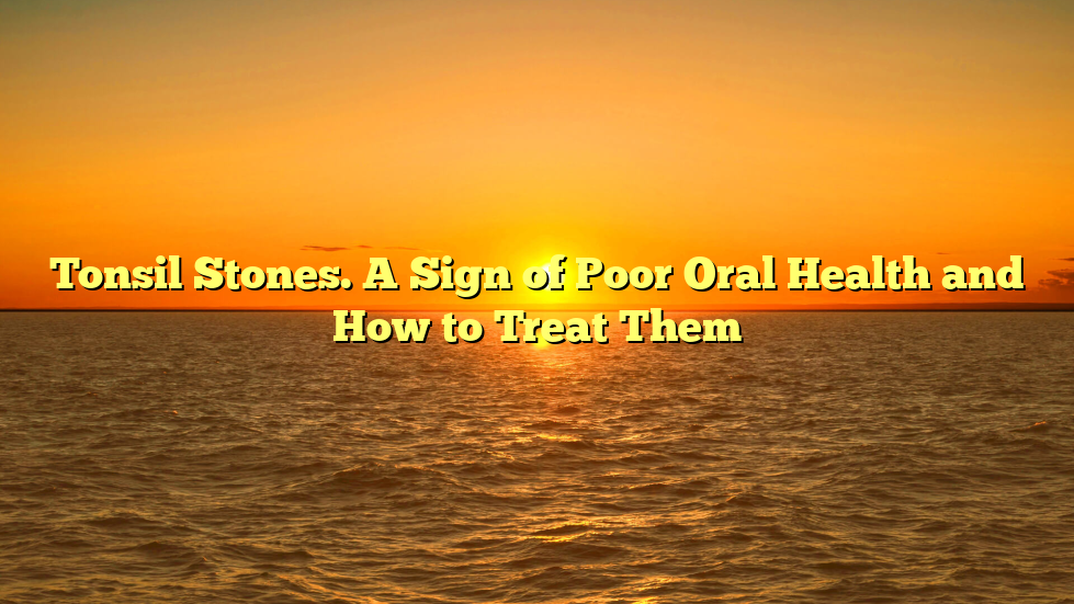 Tonsil Stones. A Sign of Poor Oral Health and How to Treat Them